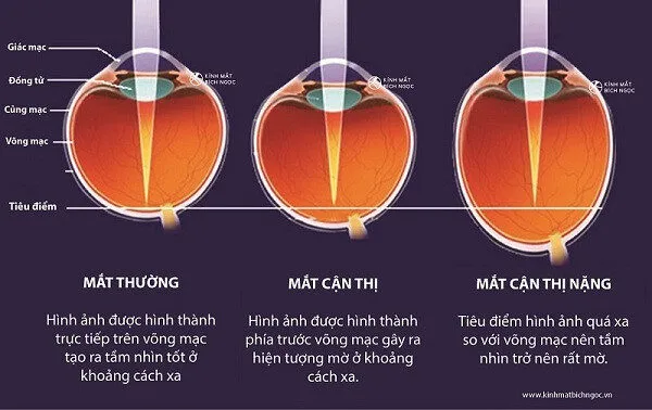 Cận thị có thể tự khỏi được không? Cách điều trị hiện nay