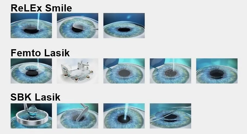 Những phương pháp Mổ Mắt Cận Thị hiện nay? Lời khuyên khi Mổ Mắt Cận