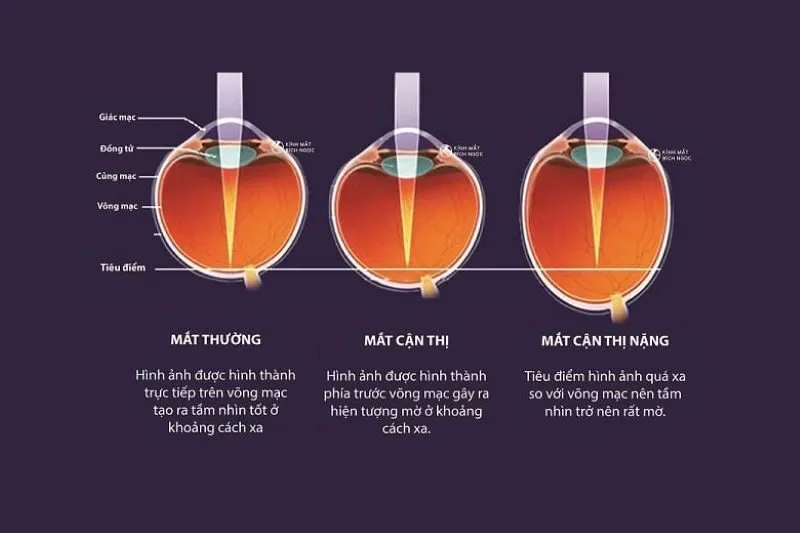 Cận Thị Nặng Nhất Là Bao Nhiêu Độ? Có Chữa Được Không?
