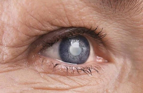 Đái tháo đường là nguyên nhân phổ biến gây phù hoàng do vi mạch máu bị tổn thương nghiêm trọng