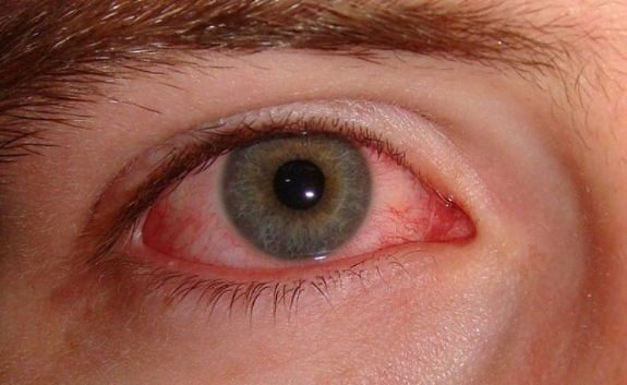 Ghèn mắt: Triệu chứng của nhiều bệnh lý cần thận trọng