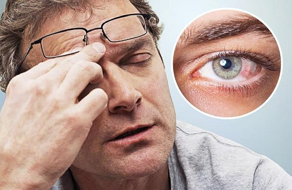 Khô mắt có thể dẫn đến tình trạng ngứa, khó chịu kéo dài