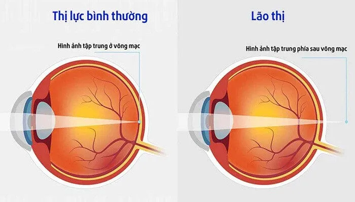 Lão Thị là bệnh gì? Cách Nhận Biết rõ ràng Và điều trị Cơ Bản
