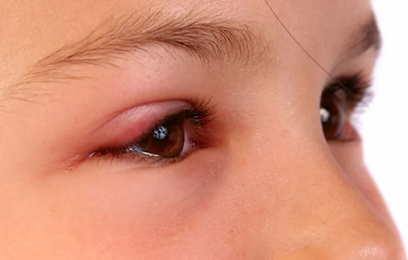 4+ Cách làm thế nào để Mắt hết sưng khi ngủ dậy