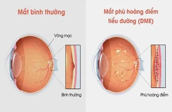 Biến chứng phù hoàng: Triệu chứng và Phương pháp điều trị