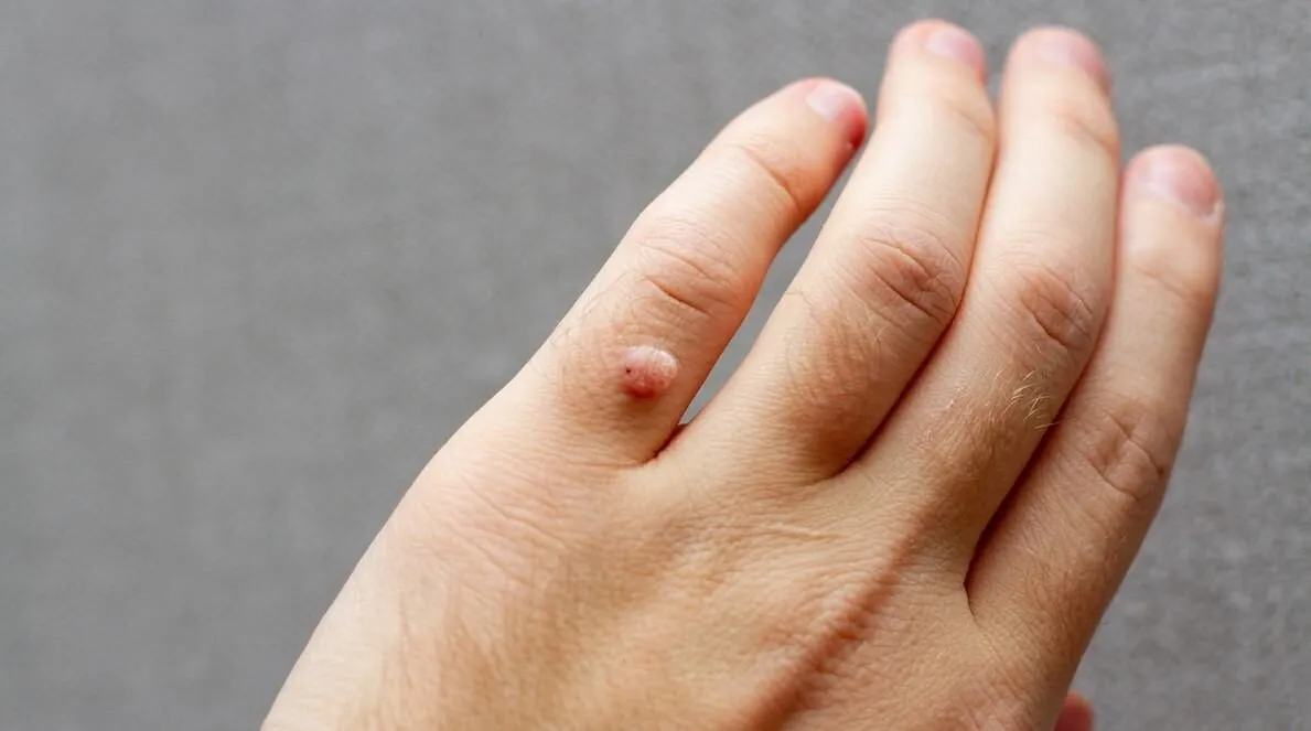 Mụn Cơm: Nguyên nhân, Điều trị và Cách phòng bệnh