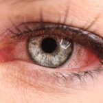 Triệu chứng của dị ứng mắt và cách điều trị dị ứng mắt hiệu quả