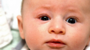 Quặm mi bẩm sinh là gì? Xử lý như thế nào?