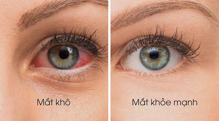 Sự khác biệt giữa mắt khỏe mạnh và mắt khô