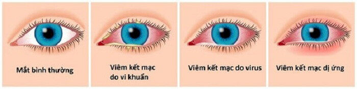 Viêm kết mạc có 4 nguyên nhân chính gây ra