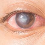 Viêm loét giác mạc do nấm – Nguyên nhân, triệu chứng và điều trị